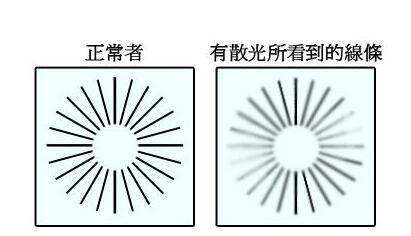 主页 特色诊疗 更多眼病【导读】散光是眼睛的一种屈光不正常